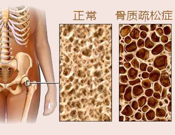 骨密度分析仪讲述骨密度低的危害/山东国康